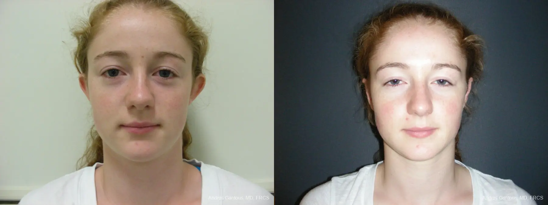 Otoplasty And Earlobe Repair: Patient 28 - Before and After 1