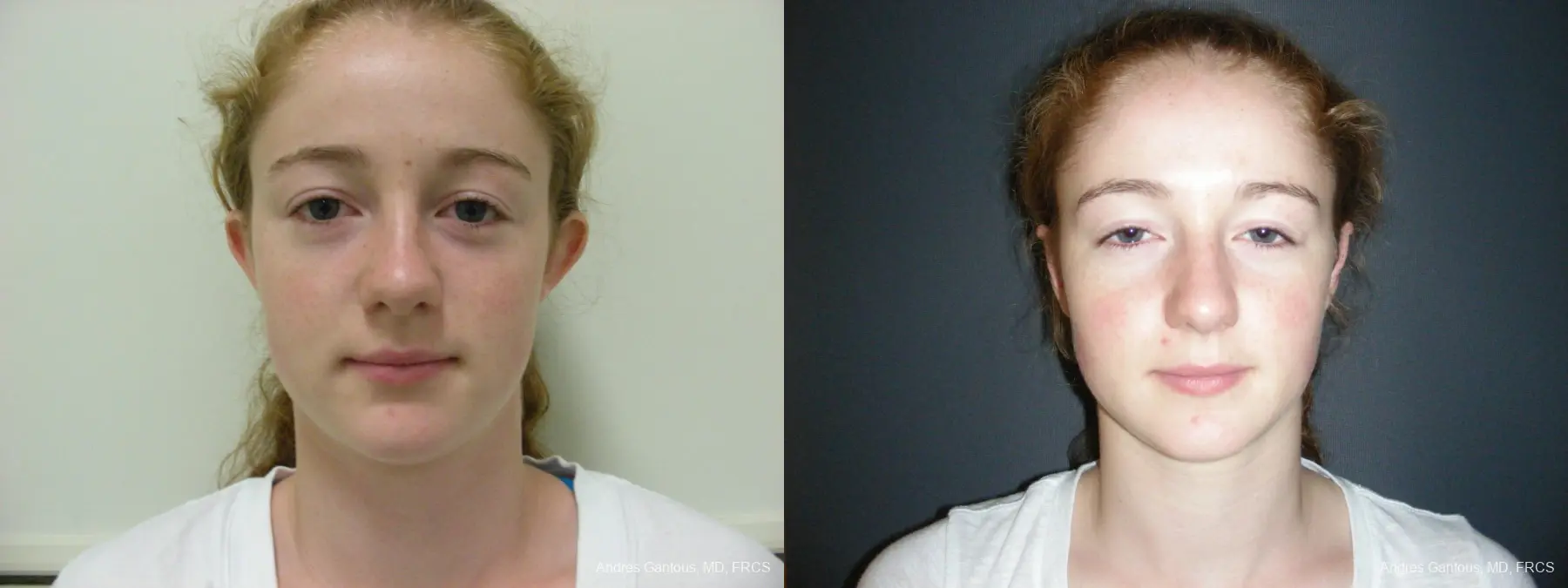 Otoplasty And Earlobe Repair: Patient 28 - Before and After  