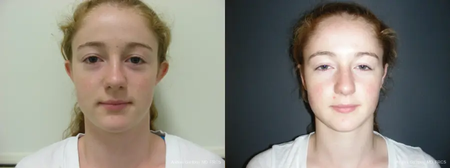 Otoplasty And Earlobe Repair: Patient 28 - Before and After