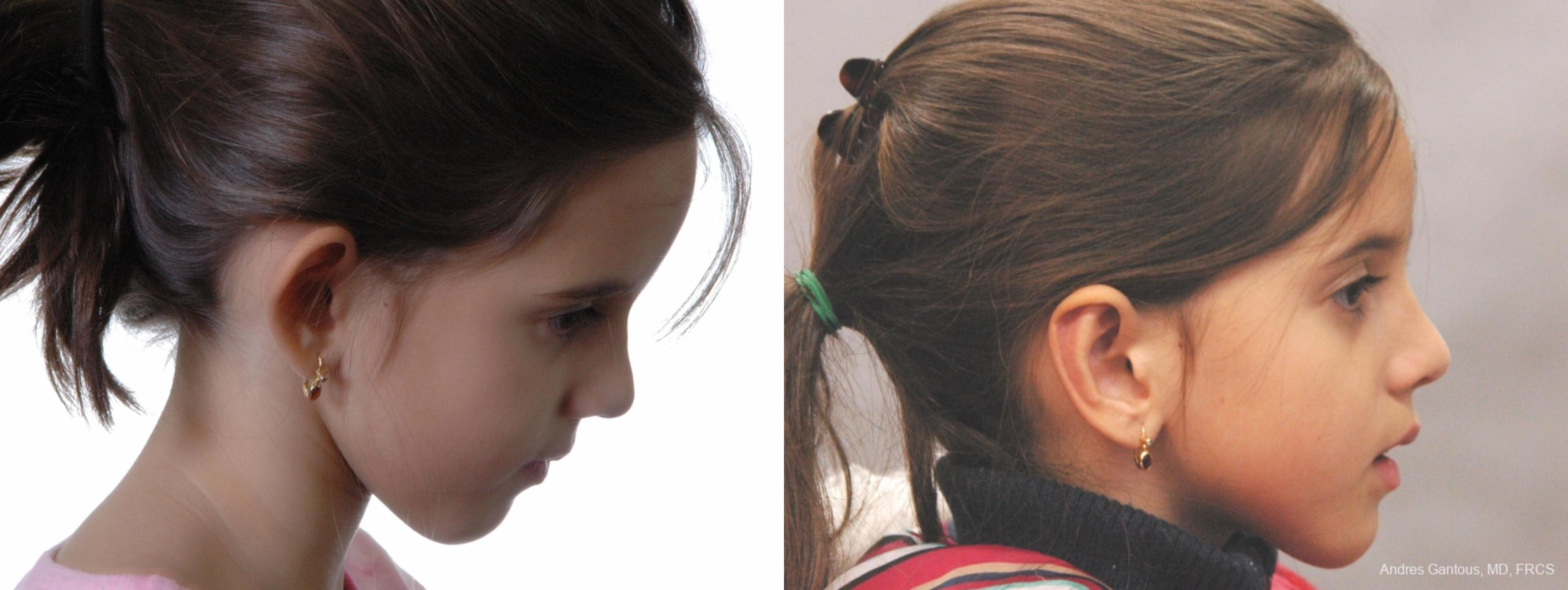 Otoplasty and Earlobe Repair - Thumbnail 2