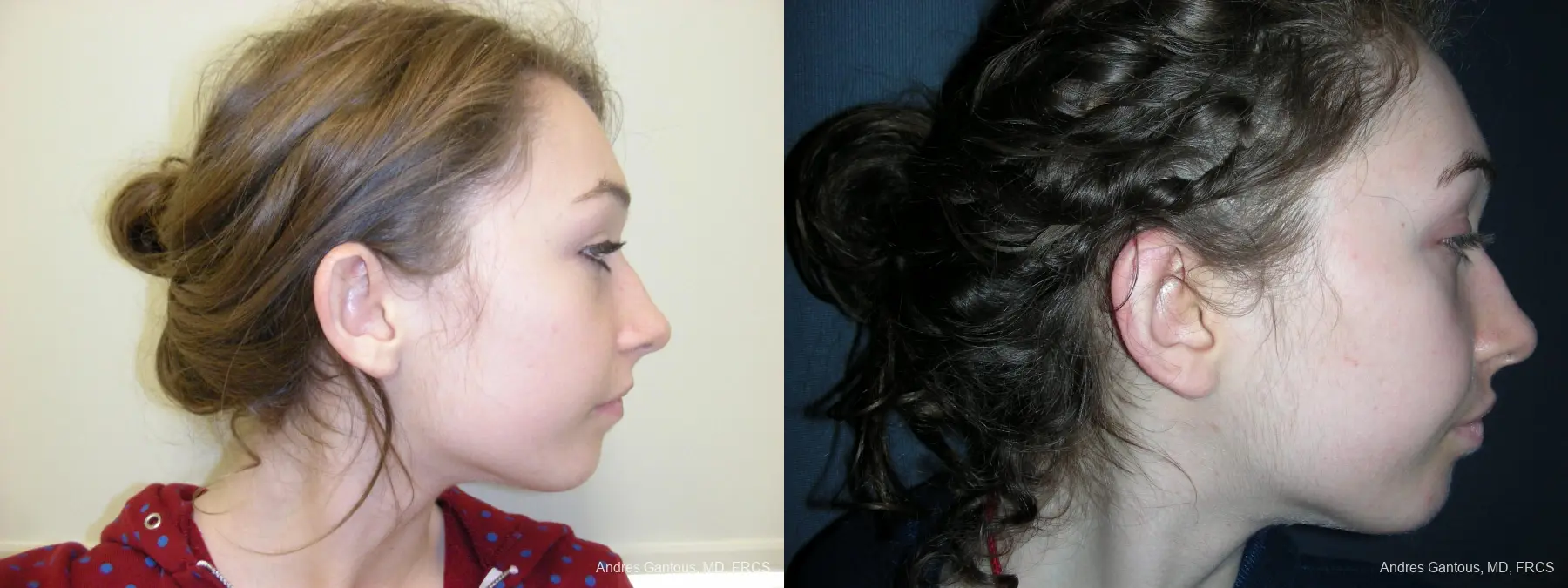 Otoplasty And Earlobe Repair: Patient 22 - Before and After 3