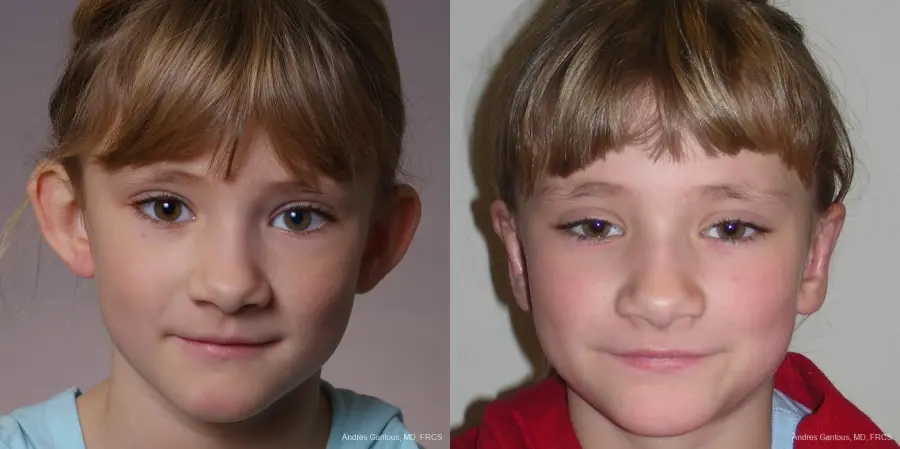 Otoplasty And Earlobe Repair: Patient 16 - Before and After