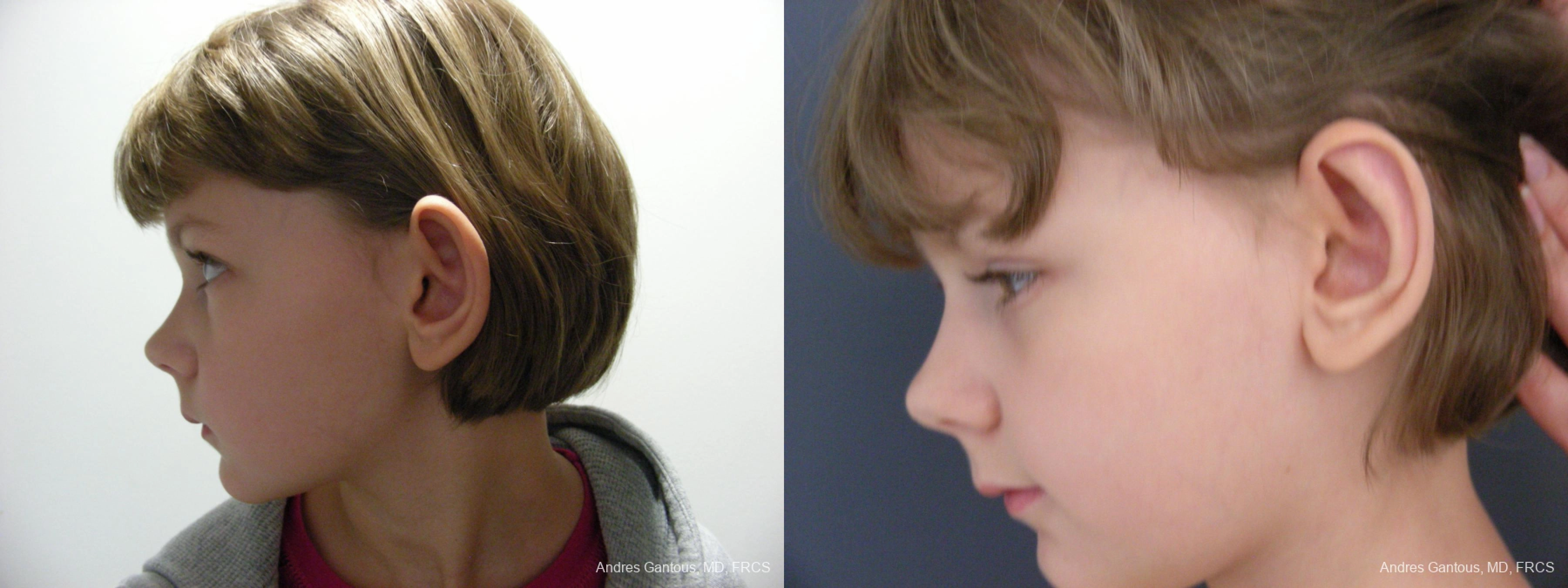 Otoplasty and Earlobe Repair - Thumbnail 5