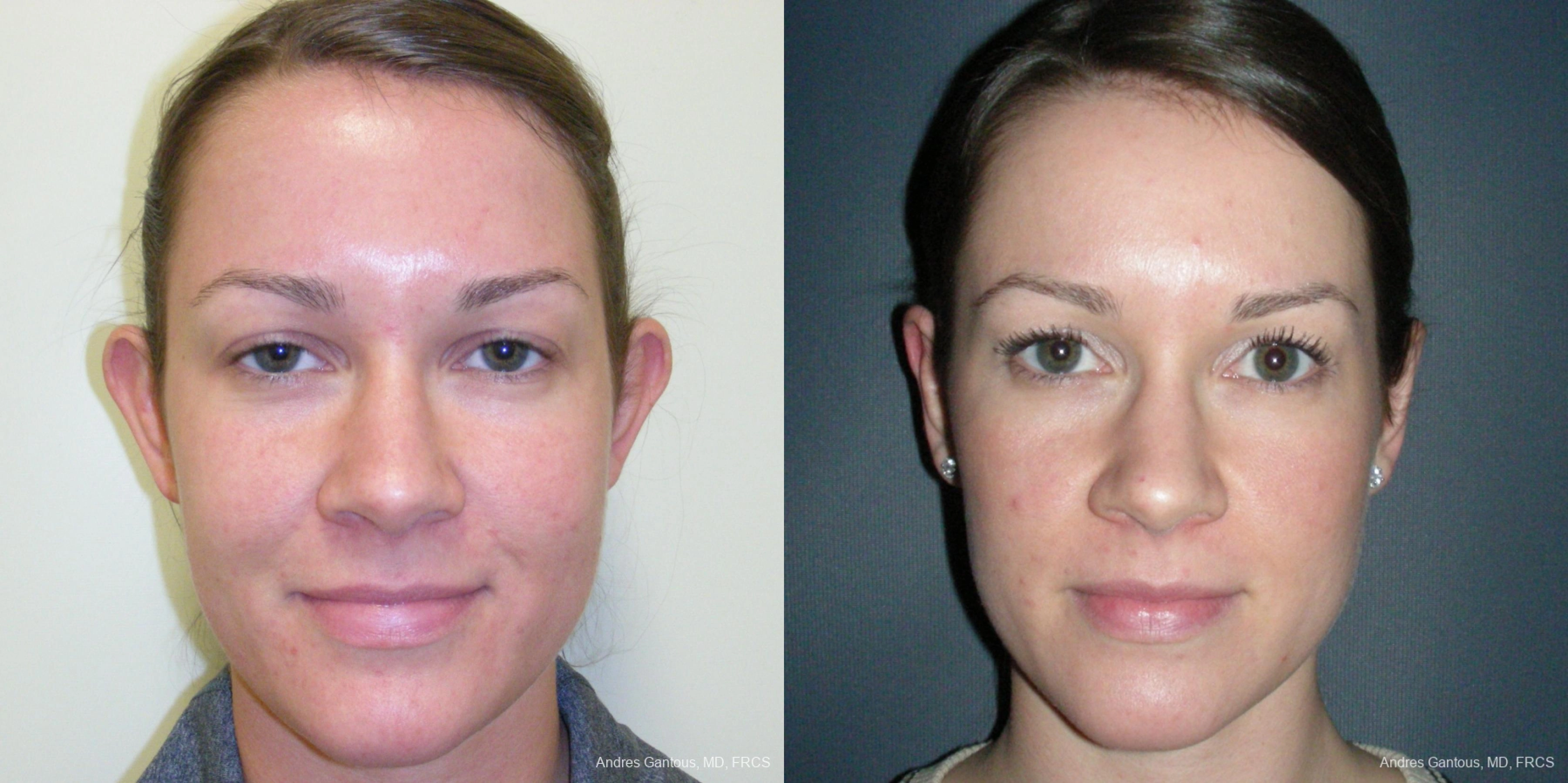 Otoplasty and Earlobe Repair - Case 11688