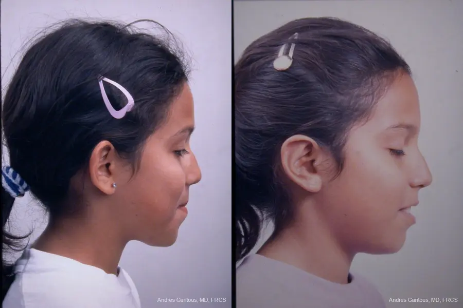 Otoplasty And Earlobe Repair: Patient 4 - Before and After 2