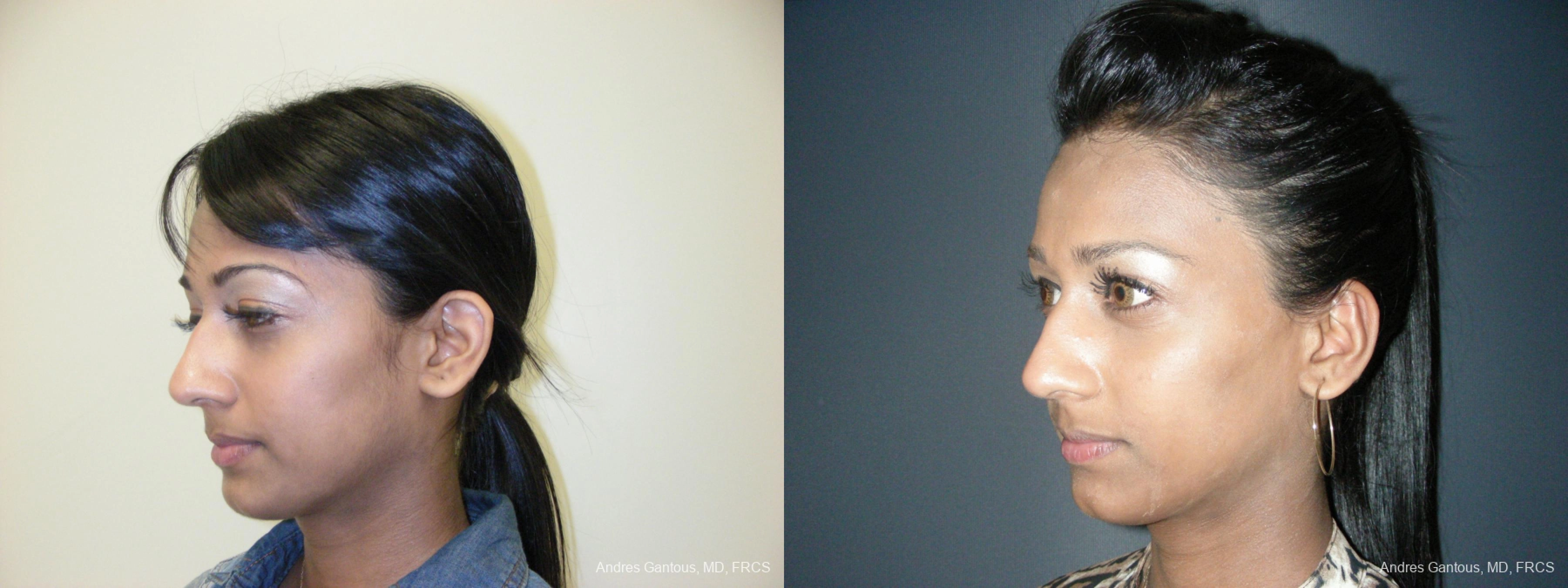 Otoplasty and Earlobe Repair - Thumbnail 4