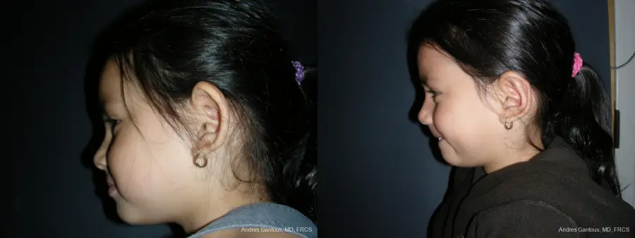 Otoplasty And Earlobe Repair: Patient 21 - Before and After 5
