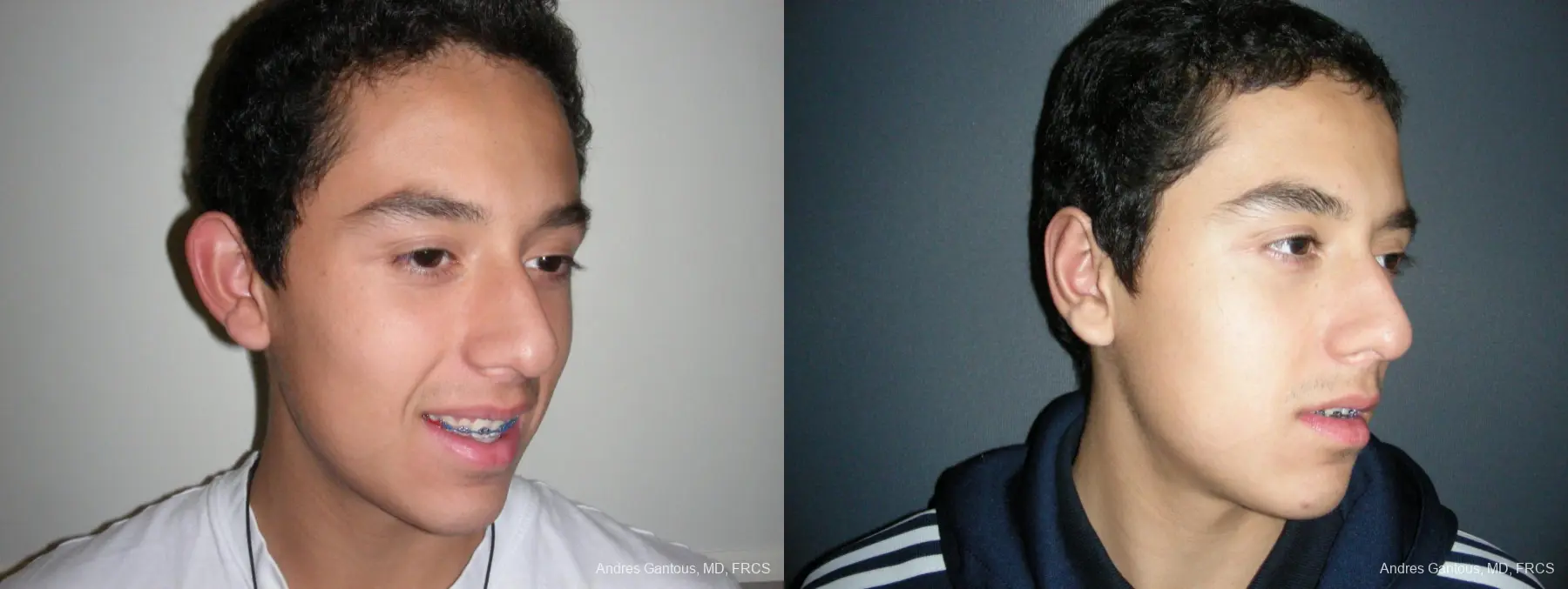 Otoplasty And Earlobe Repair: Patient 5 - Before and After 2