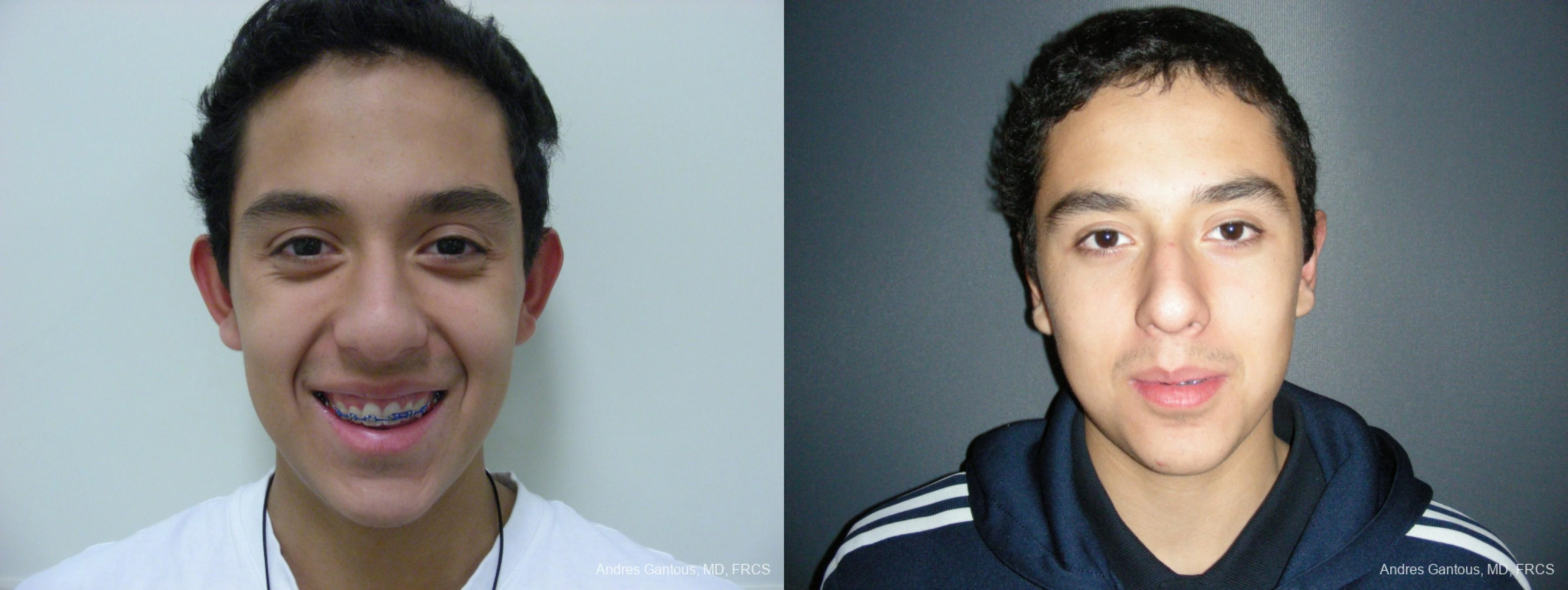 Otoplasty and Earlobe Repair - Case 11676