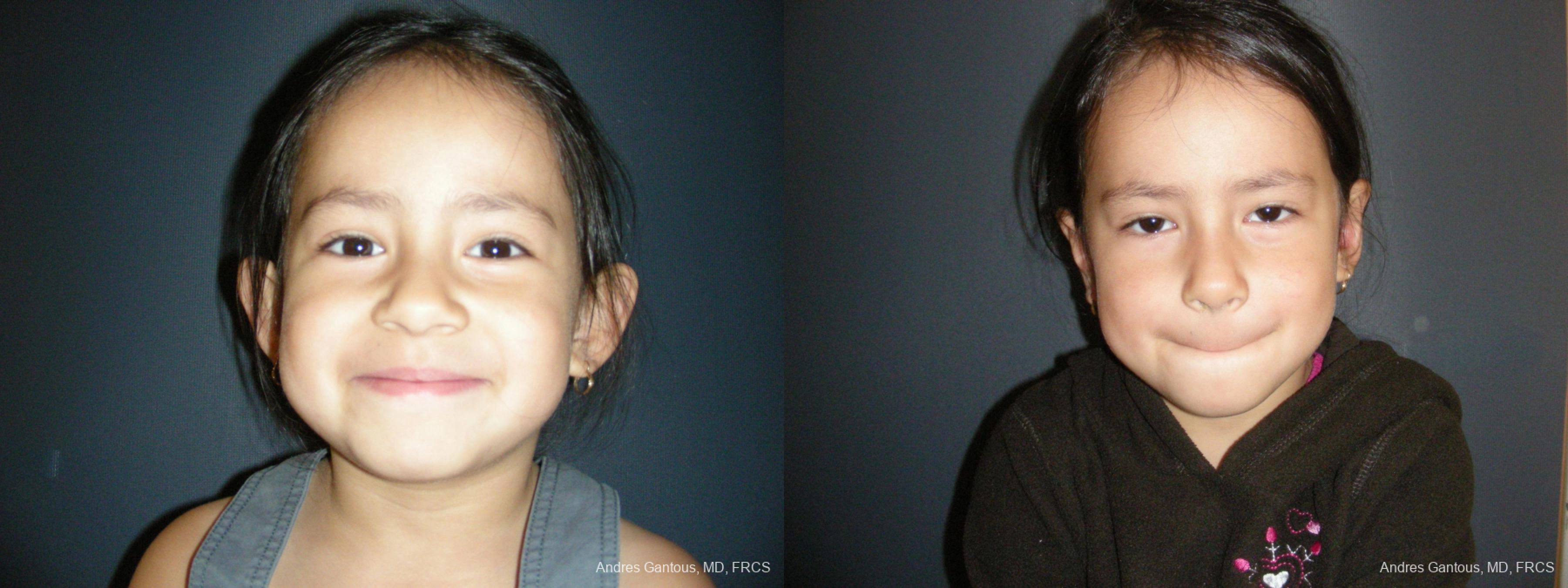 Otoplasty and Earlobe Repair - Case 6333