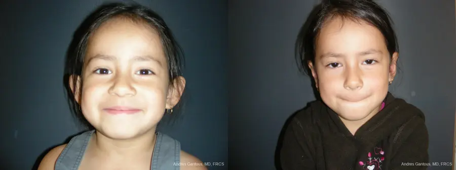 Otoplasty And Earlobe Repair: Patient 21 - Before and After