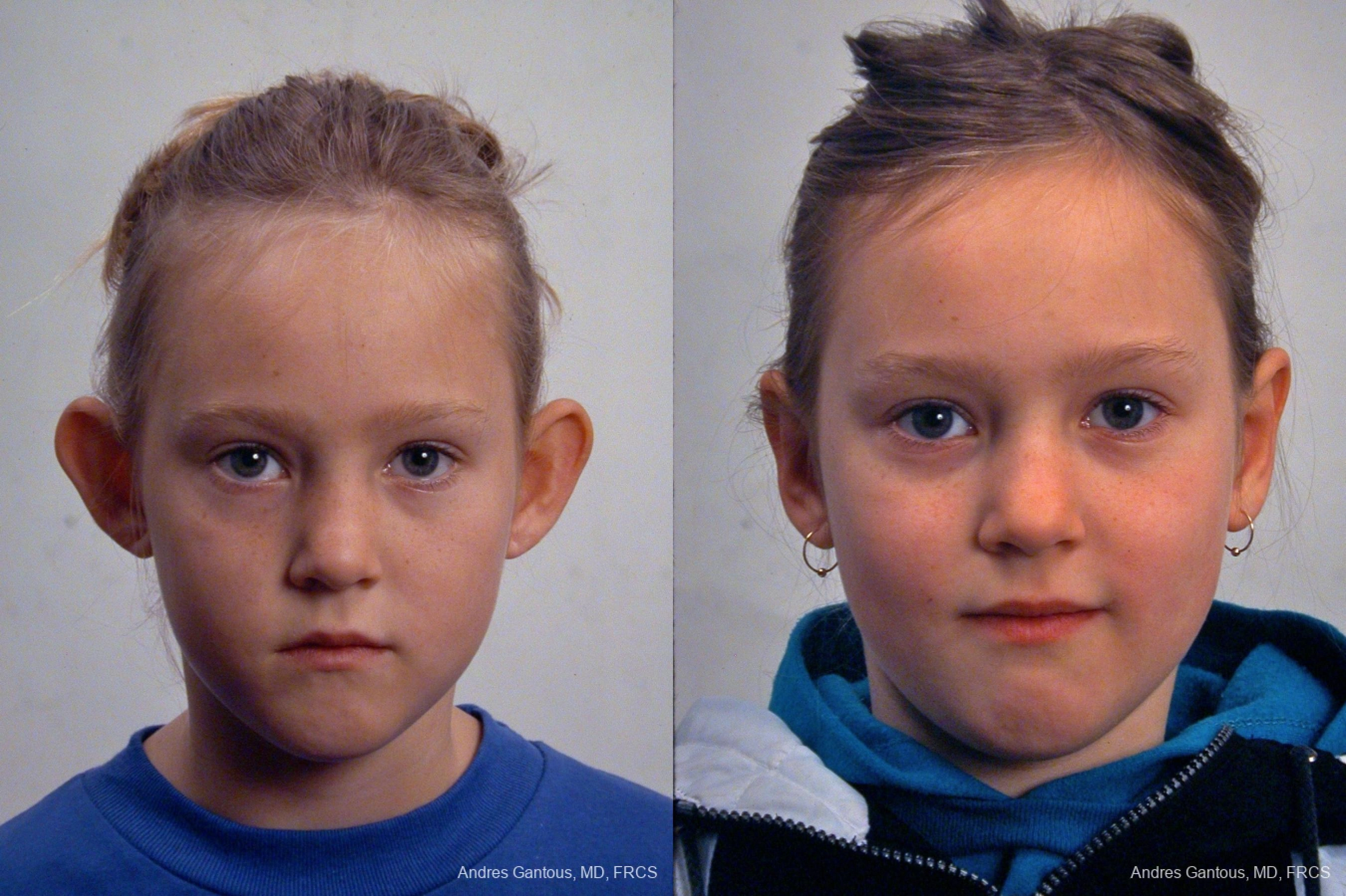 Otoplasty and Earlobe Repair - Case 11719