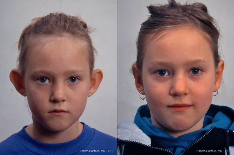 Otoplasty And Earlobe Repair: Patient 23 - Before and After
