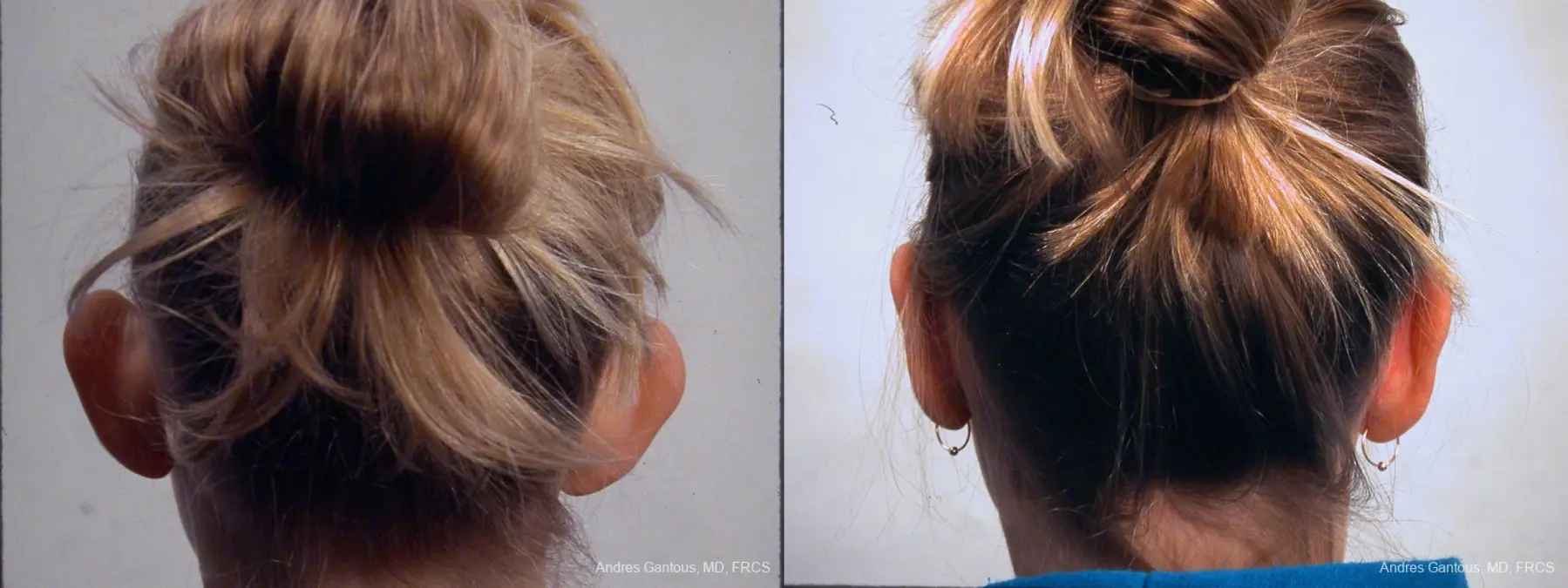 Otoplasty And Earlobe Repair: Patient 23 - Before and After 4
