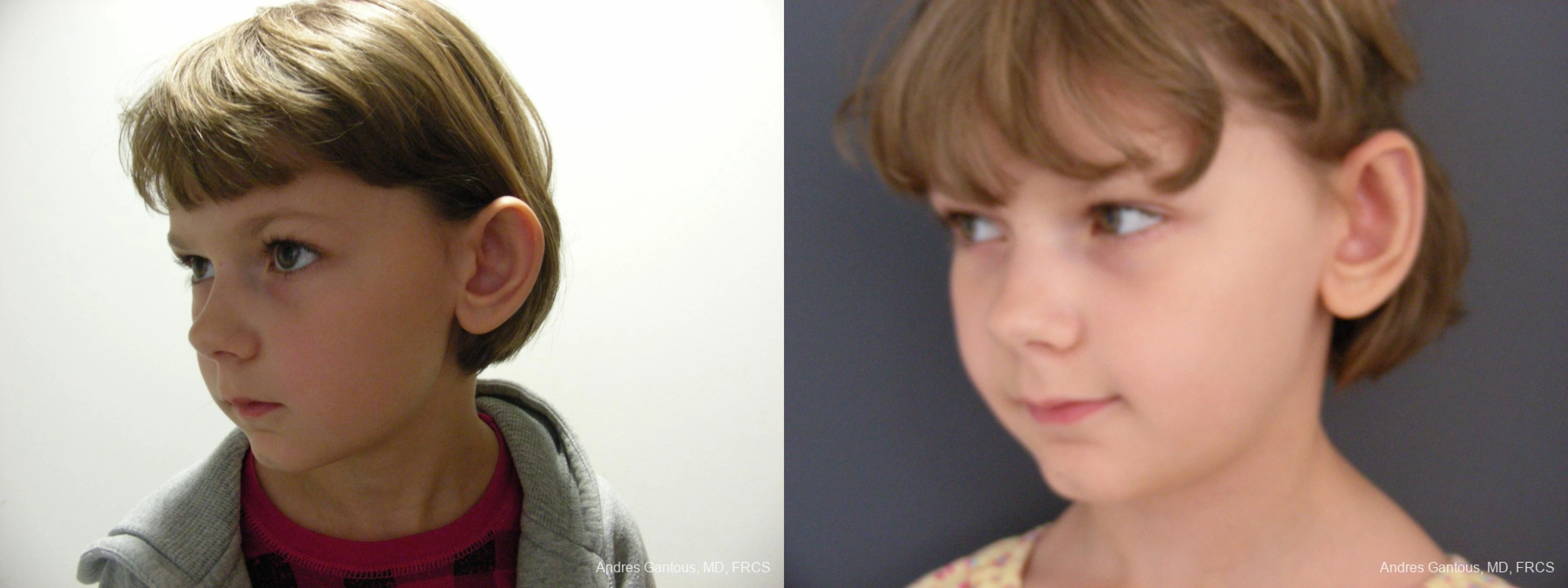 Otoplasty and Earlobe Repair - Thumbnail 4