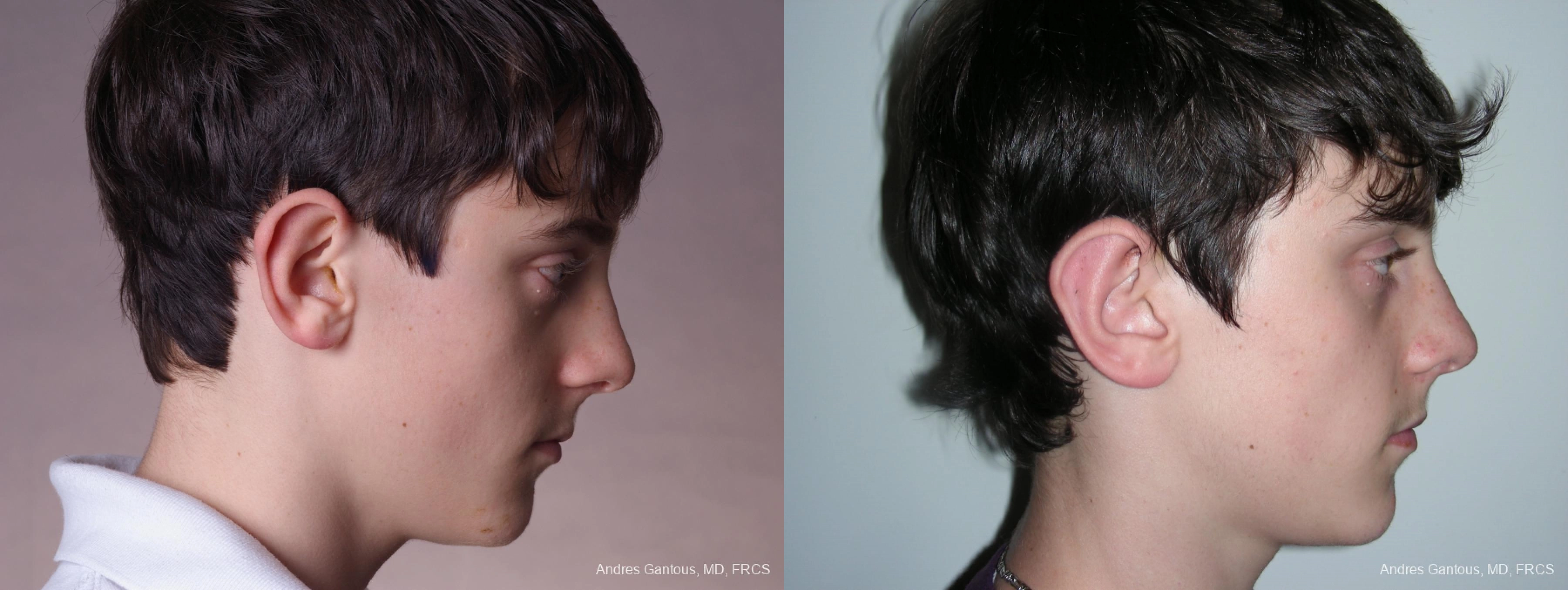 Otoplasty and Earlobe Repair - Thumbnail 3