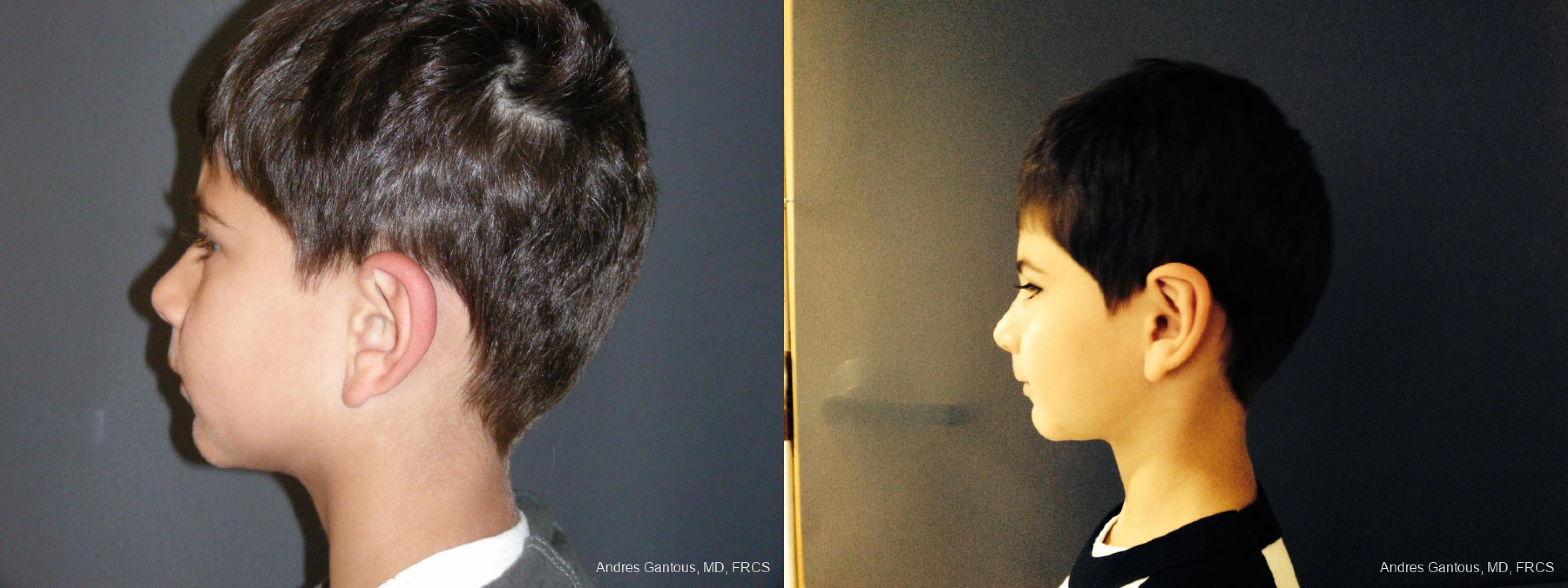 Otoplasty and Earlobe Repair - Thumbnail 5