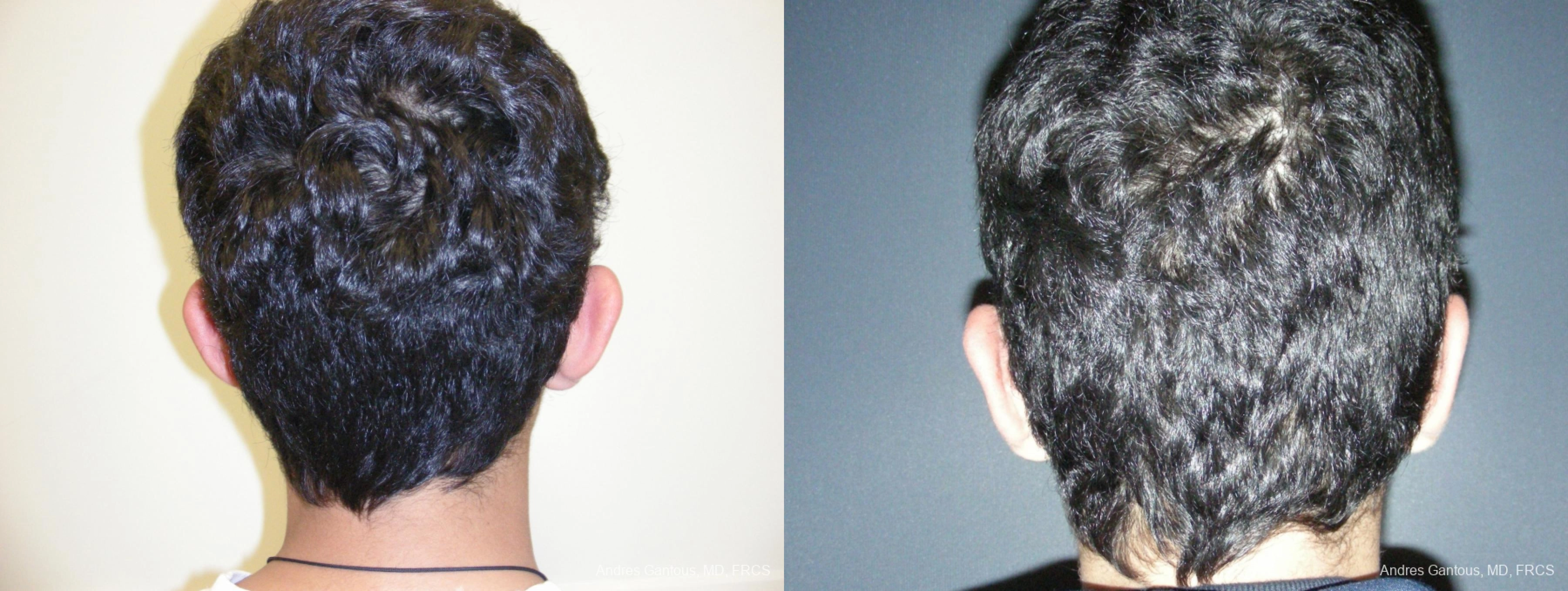 Otoplasty and Earlobe Repair - Thumbnail 6