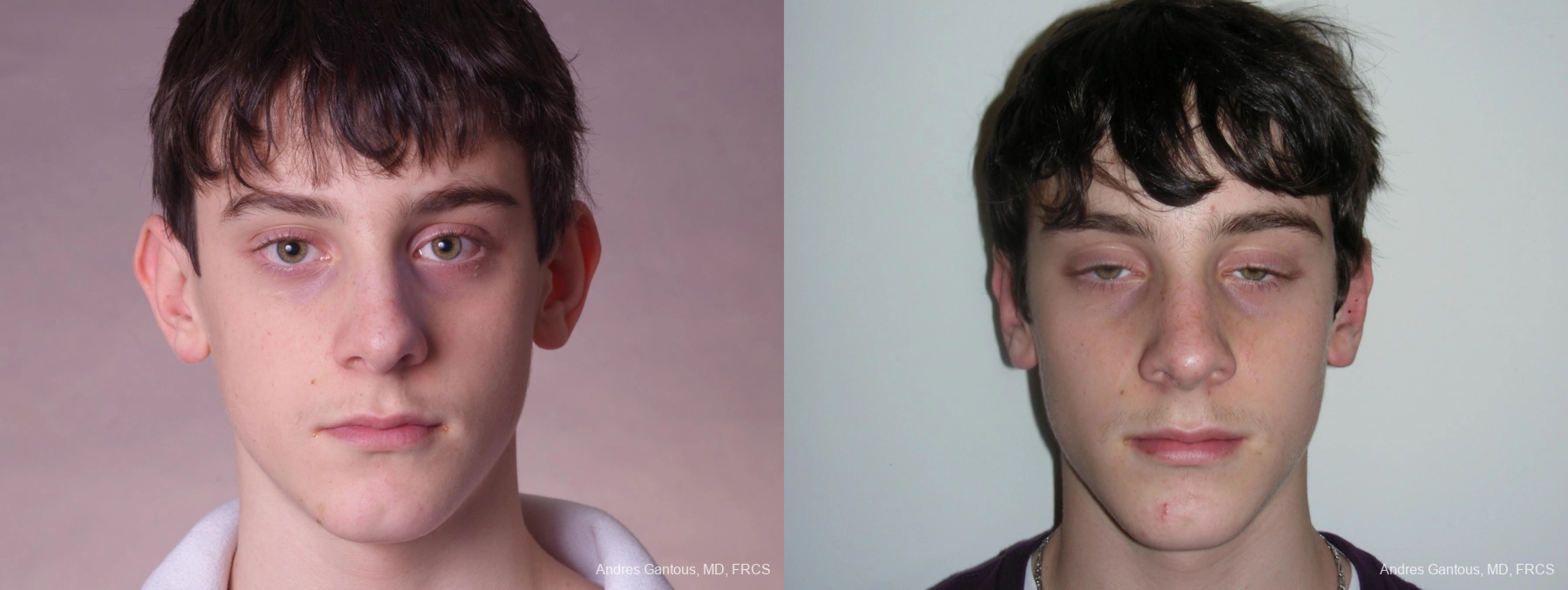 Otoplasty and Earlobe Repair - Case 11674