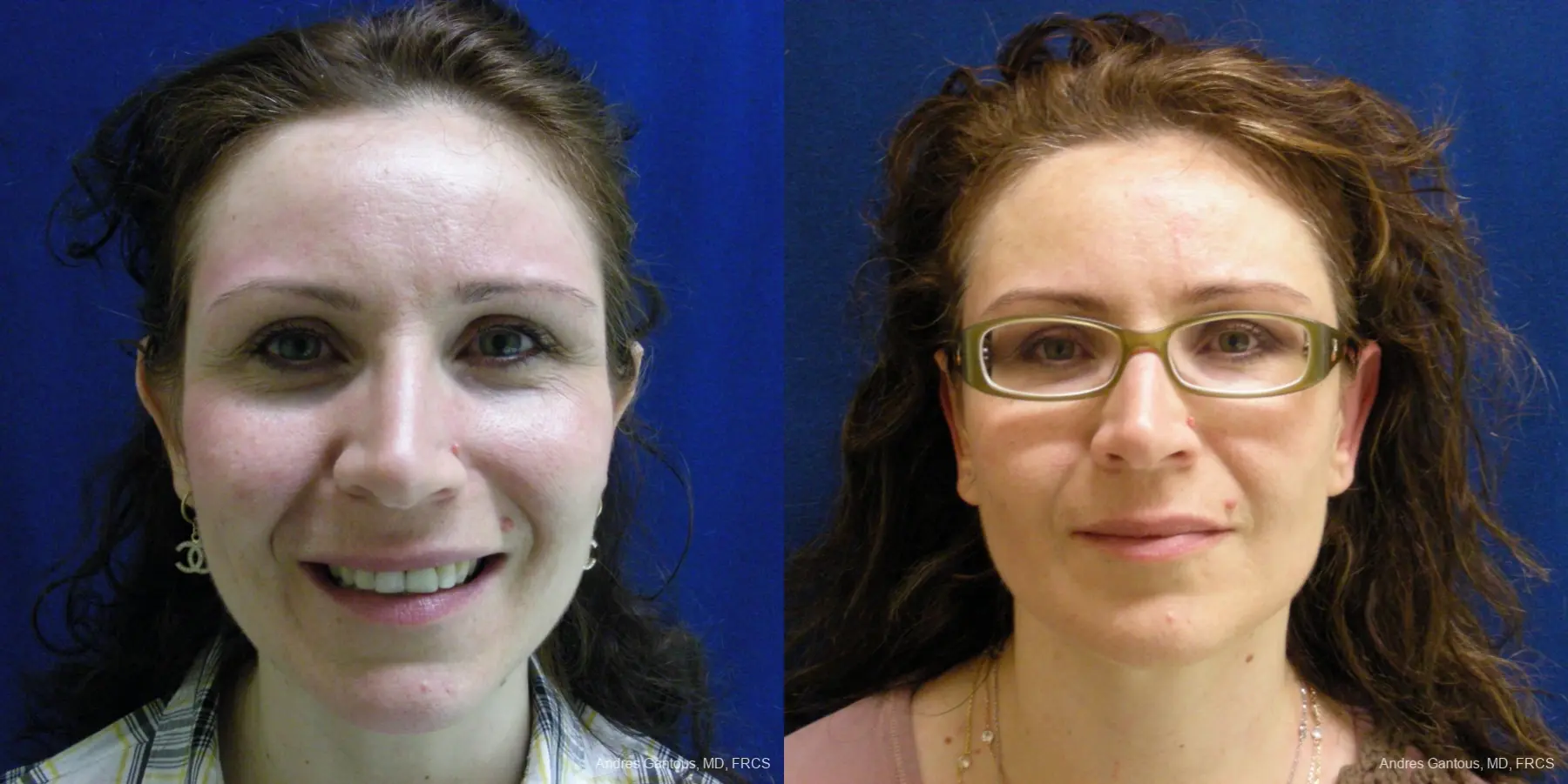 Otoplasty And Earlobe Repair: Patient 11 - Before and After  