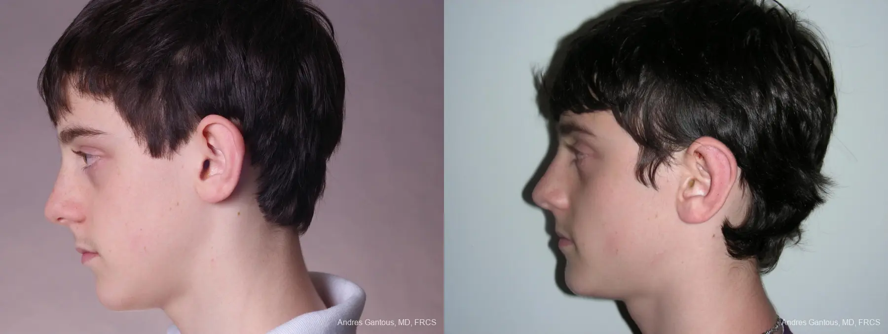 Otoplasty And Earlobe Repair: Patient 3 - Before and After 5