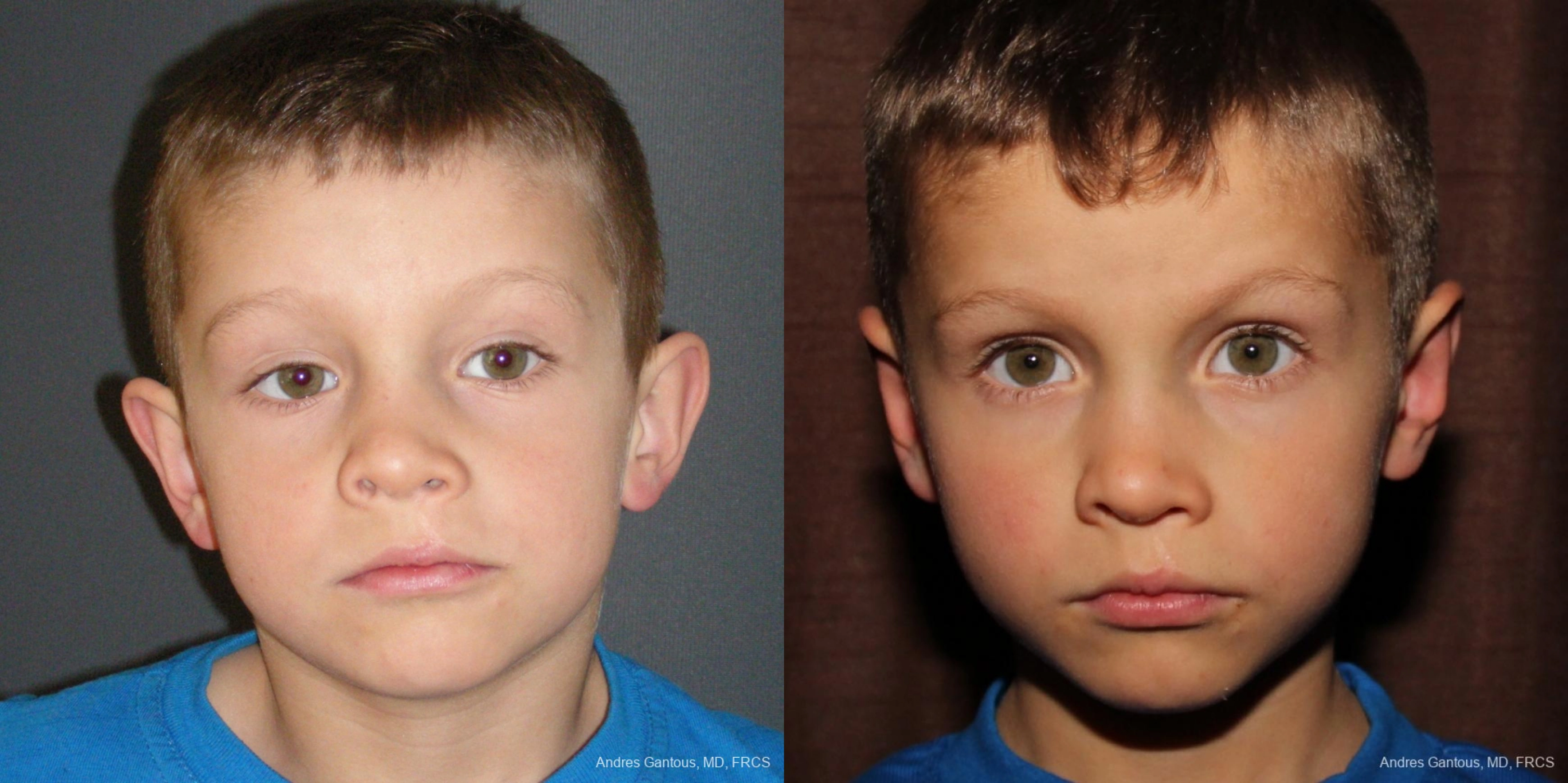 Otoplasty and Earlobe Repair - Case 11692