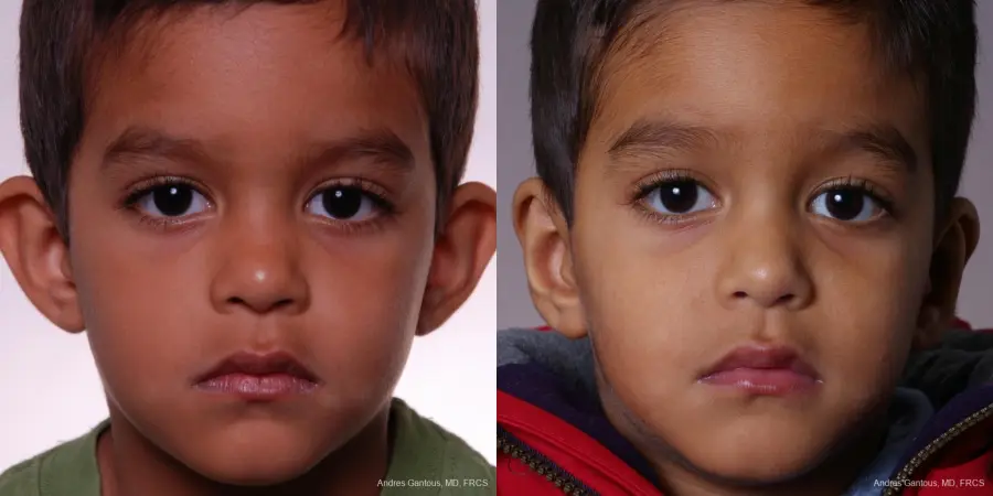 Otoplasty And Earlobe Repair: Patient 13 - Before and After