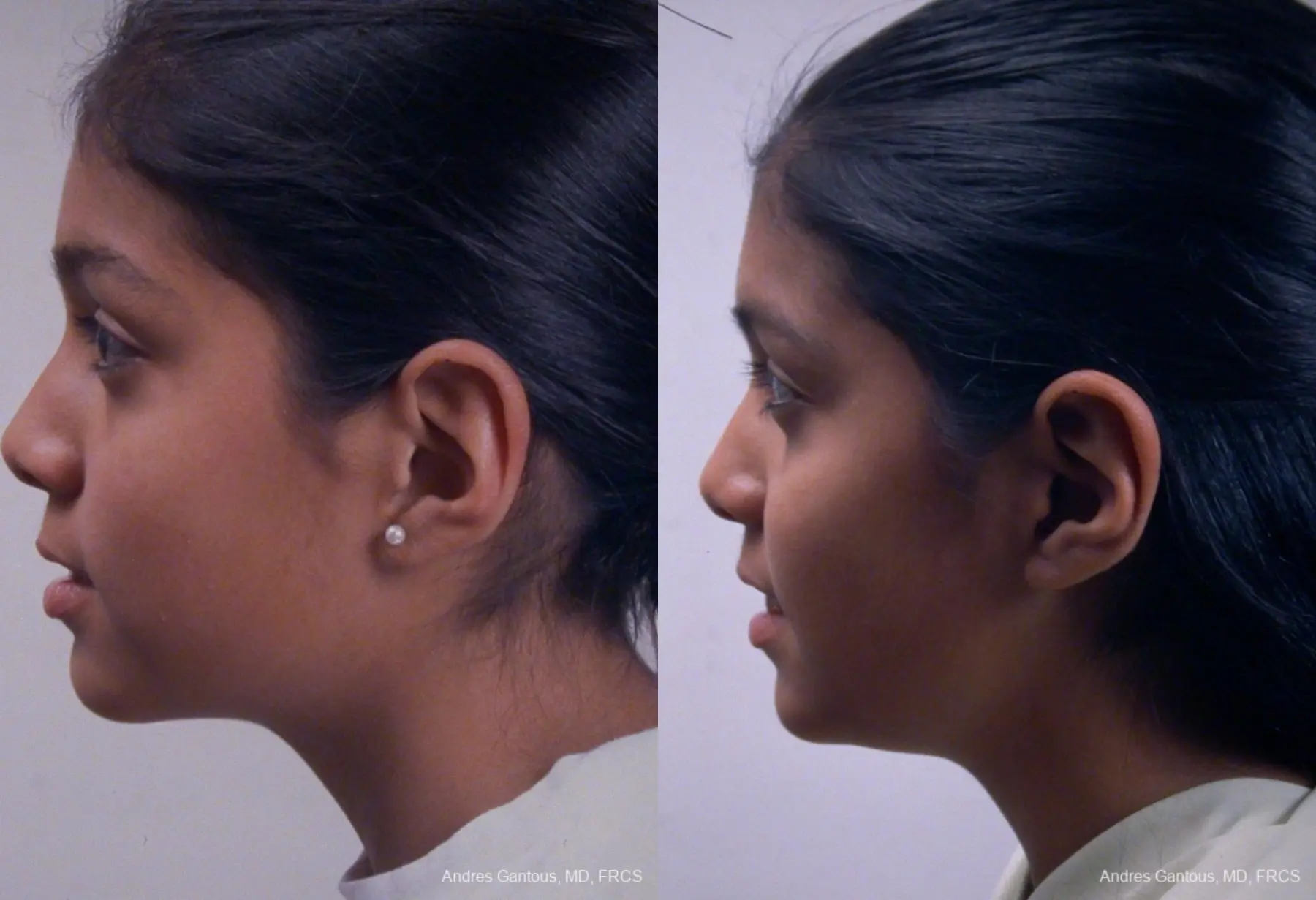 Otoplasty And Earlobe Repair: Patient 25 - Before and After 5