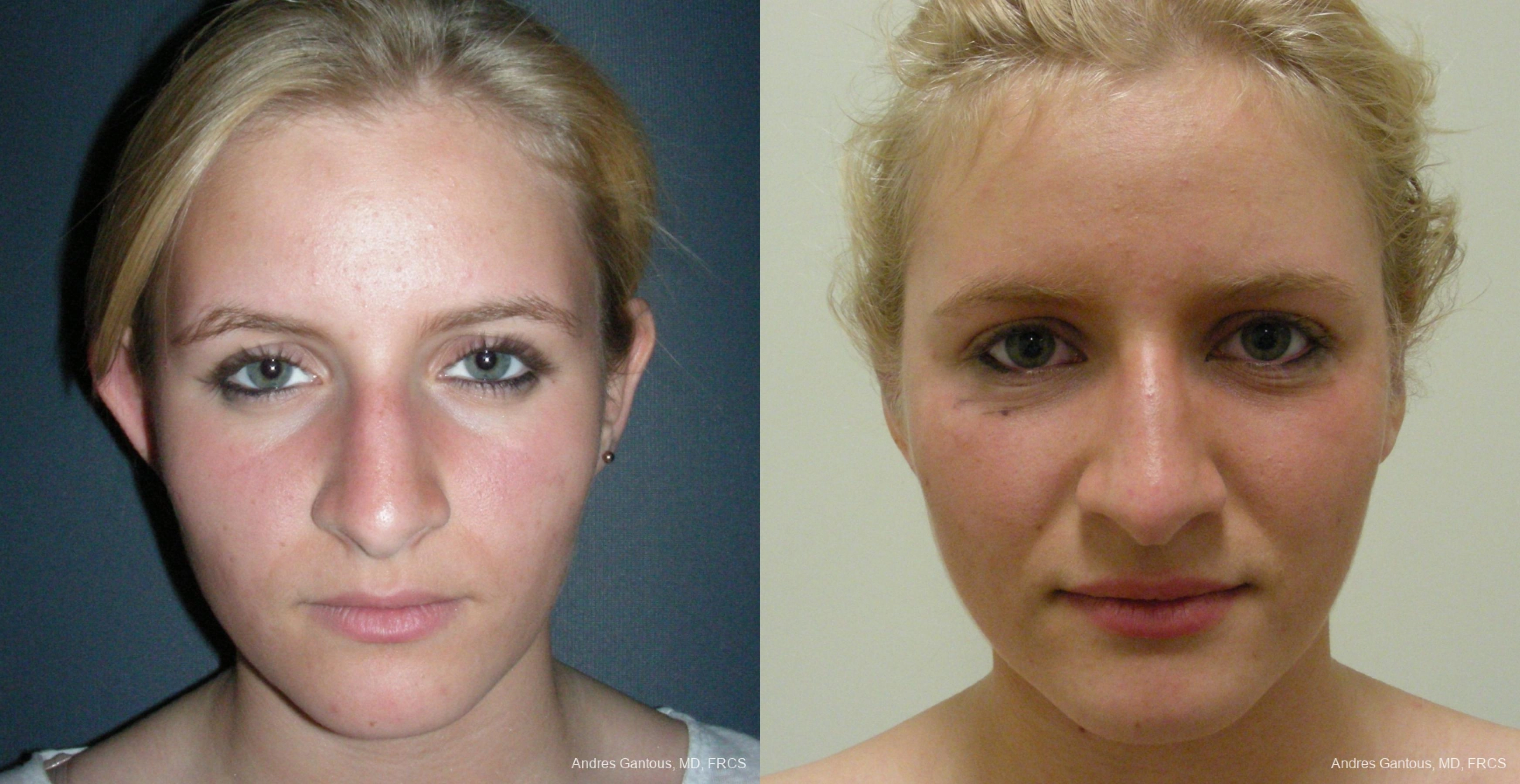 Otoplasty and Earlobe Repair - Case 11699