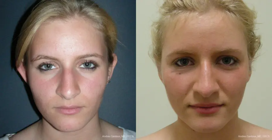 Otoplasty And Earlobe Repair: Patient 17 - Before and After