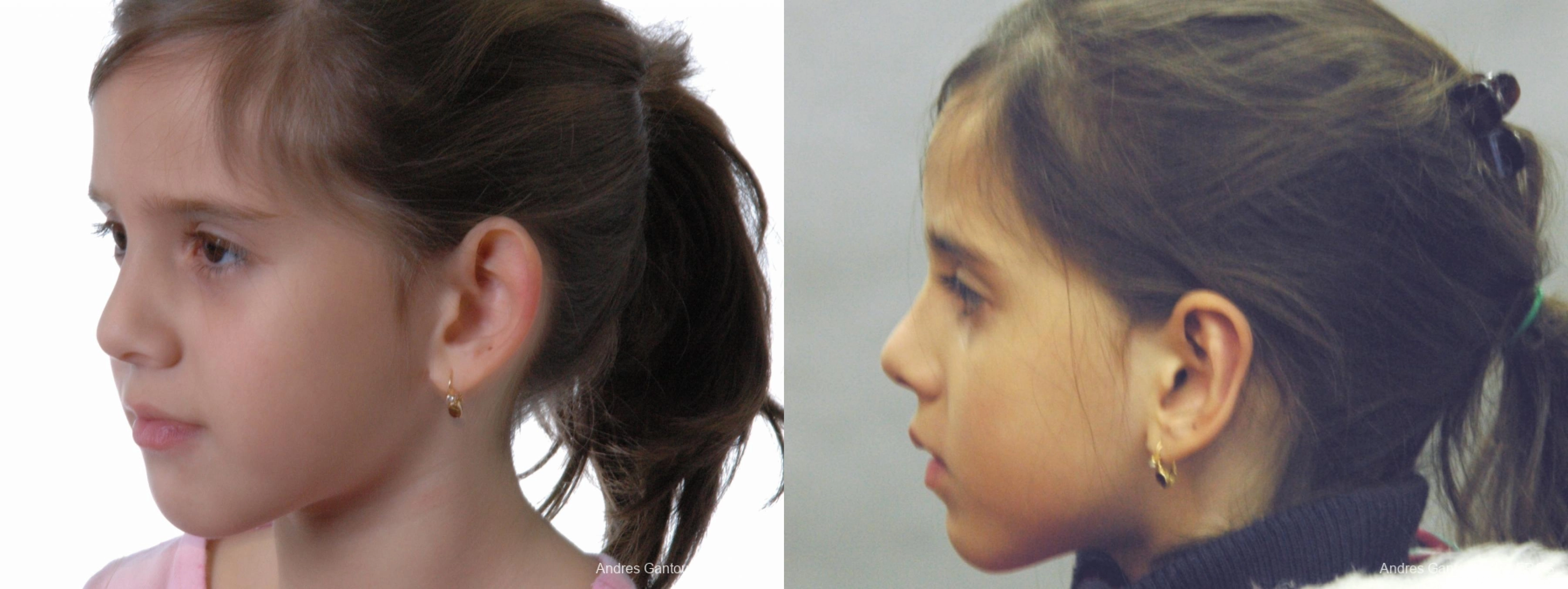 Otoplasty and Earlobe Repair - Thumbnail 3