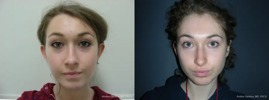 Otoplasty And Earlobe Repair: Patient 22 - Before and After