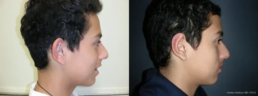 Otoplasty And Earlobe Repair: Patient 5 - Before and After 3
