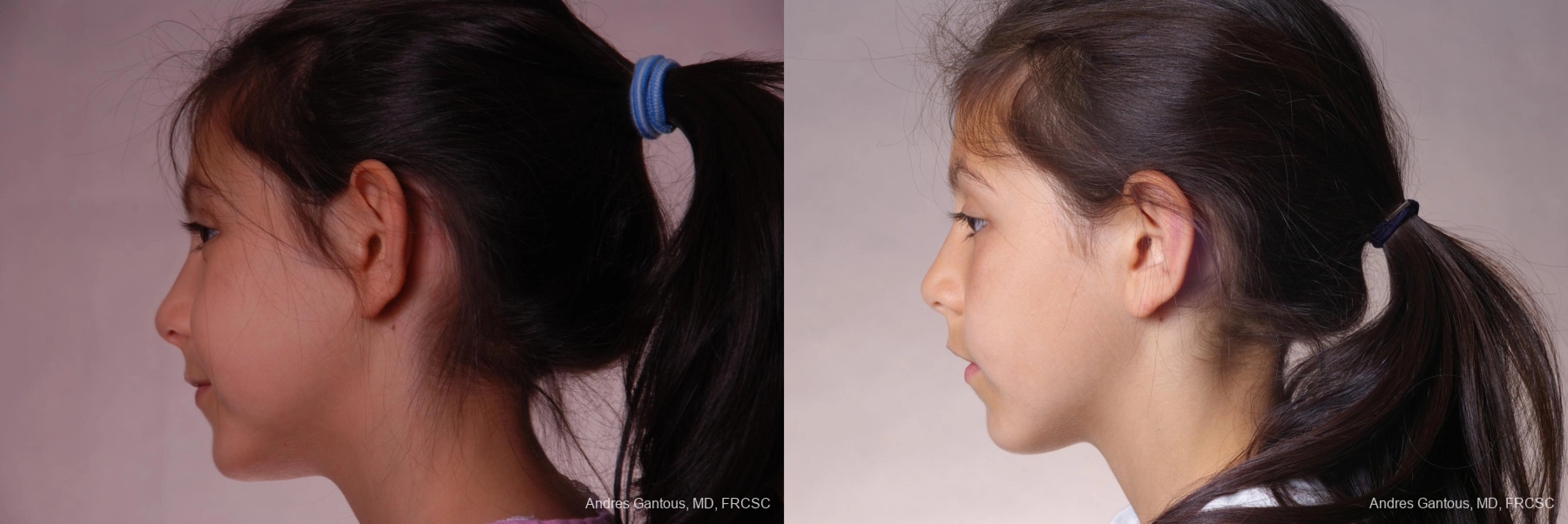 Otoplasty and Earlobe Repair - Thumbnail 5