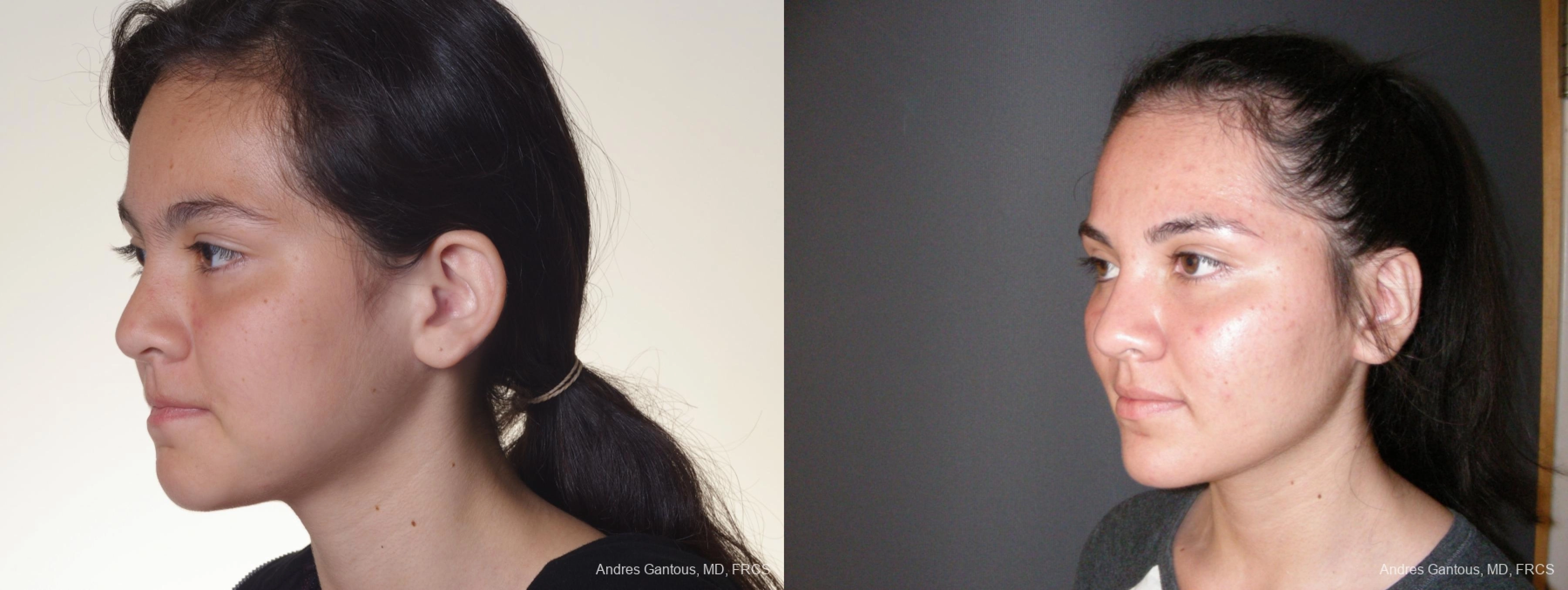 Otoplasty and Earlobe Repair - Thumbnail 4