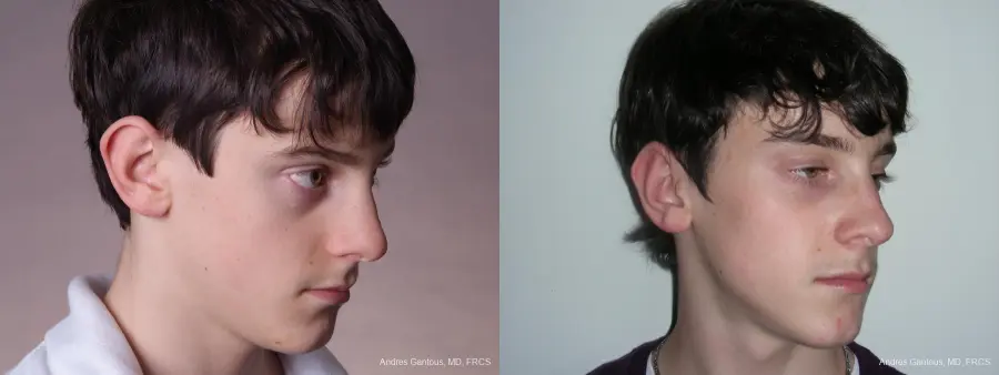 Otoplasty And Earlobe Repair: Patient 3 - Before and After 2