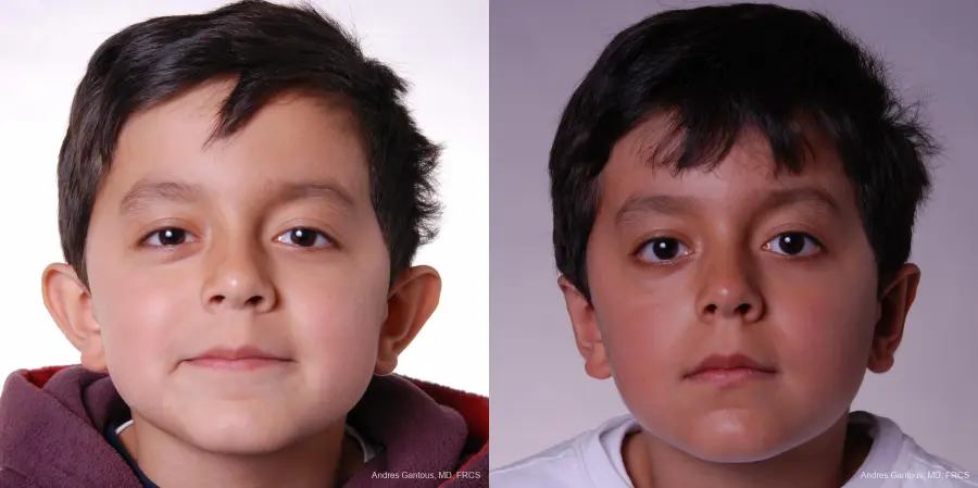 Otoplasty And Earlobe Repair: Patient 14 - Before and After