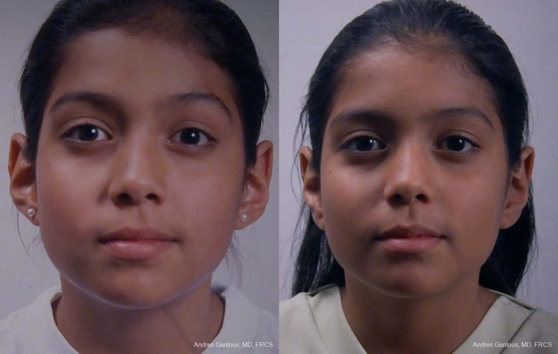 Otoplasty And Earlobe Repair: Patient 25 - Before and After 1
