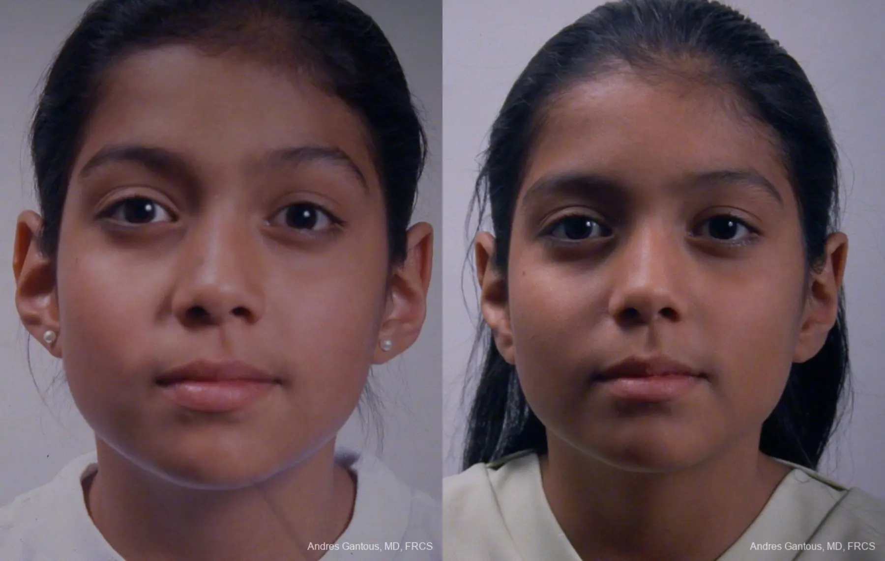 Otoplasty And Earlobe Repair: Patient 25 - Before and After  