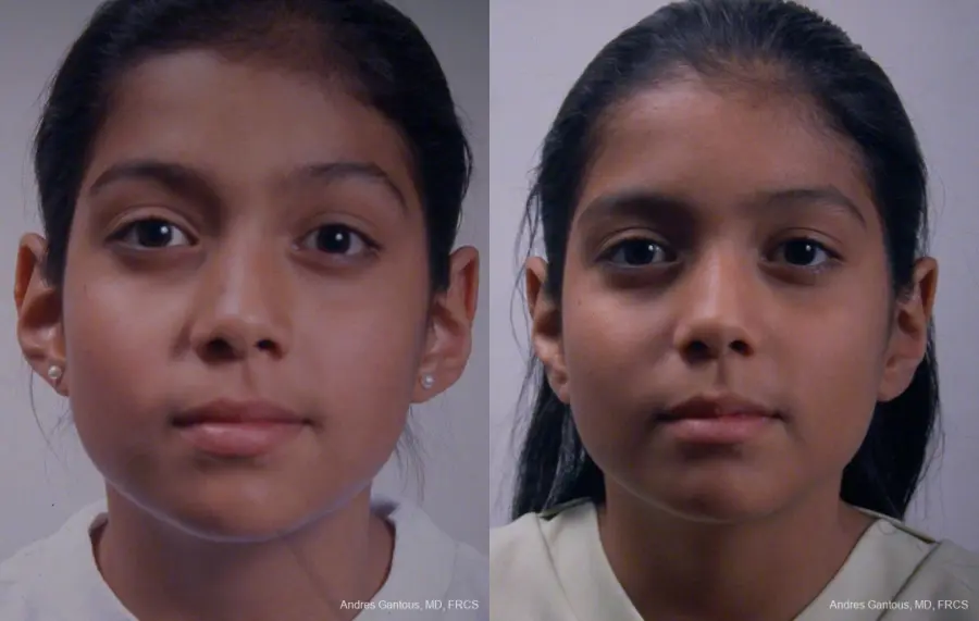 Otoplasty And Earlobe Repair: Patient 25 - Before and After