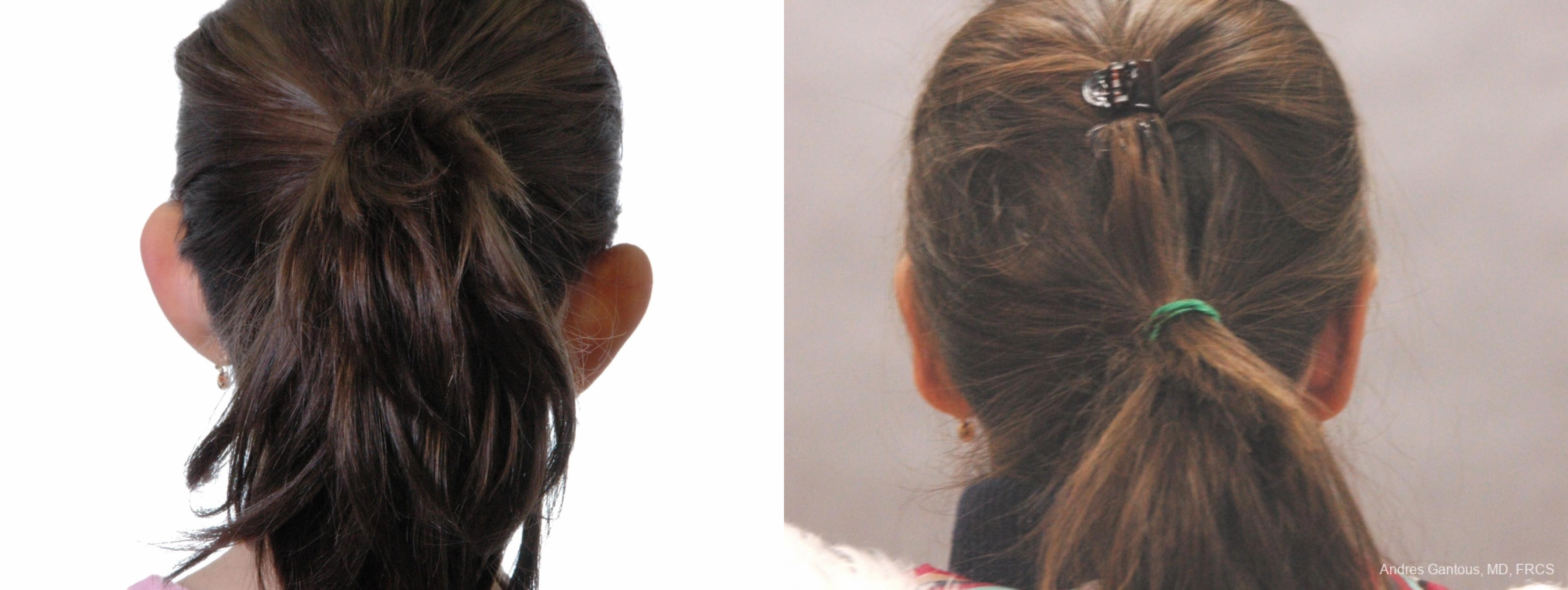 Otoplasty and Earlobe Repair - Thumbnail 4