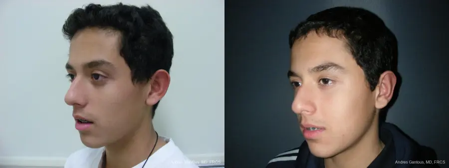 Otoplasty And Earlobe Repair: Patient 5 - Before and After 4