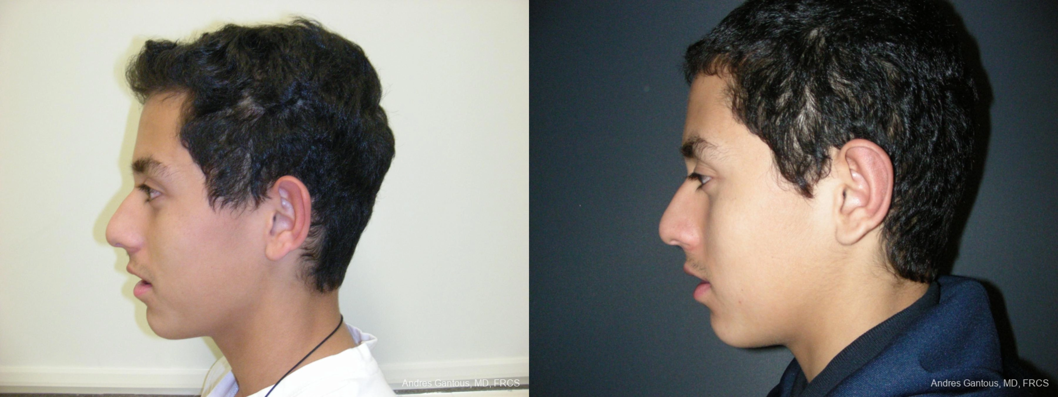 Otoplasty and Earlobe Repair - Thumbnail 5