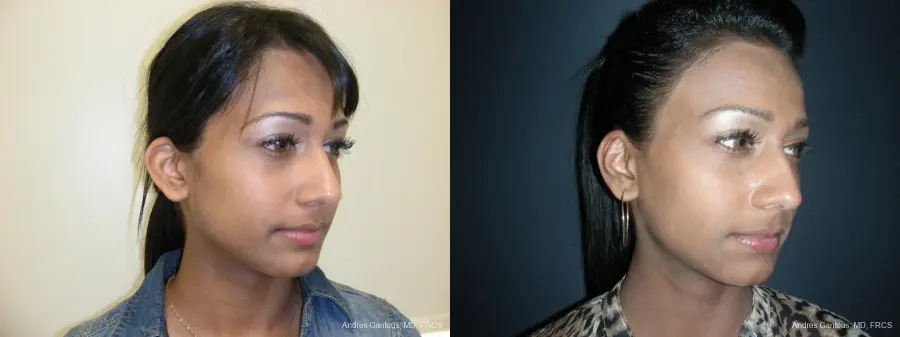 Otoplasty And Earlobe Repair: Patient 19 - Before and After 2