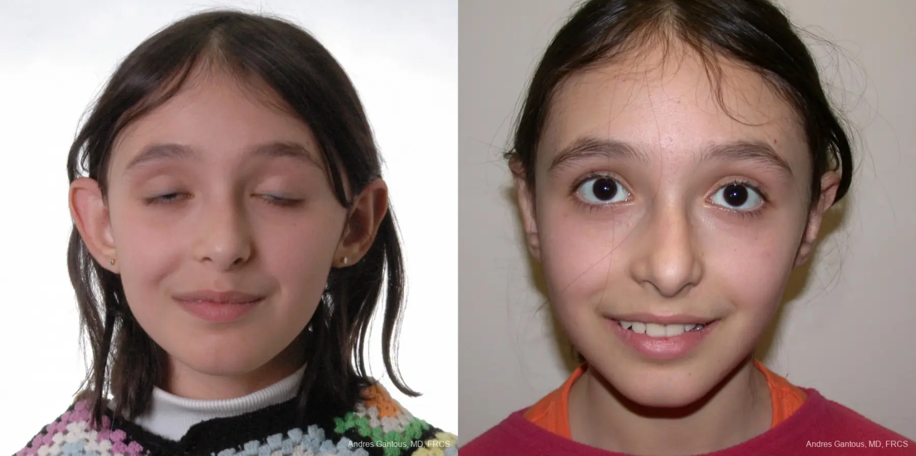 Otoplasty And Earlobe Repair: Patient 8 - Before and After  