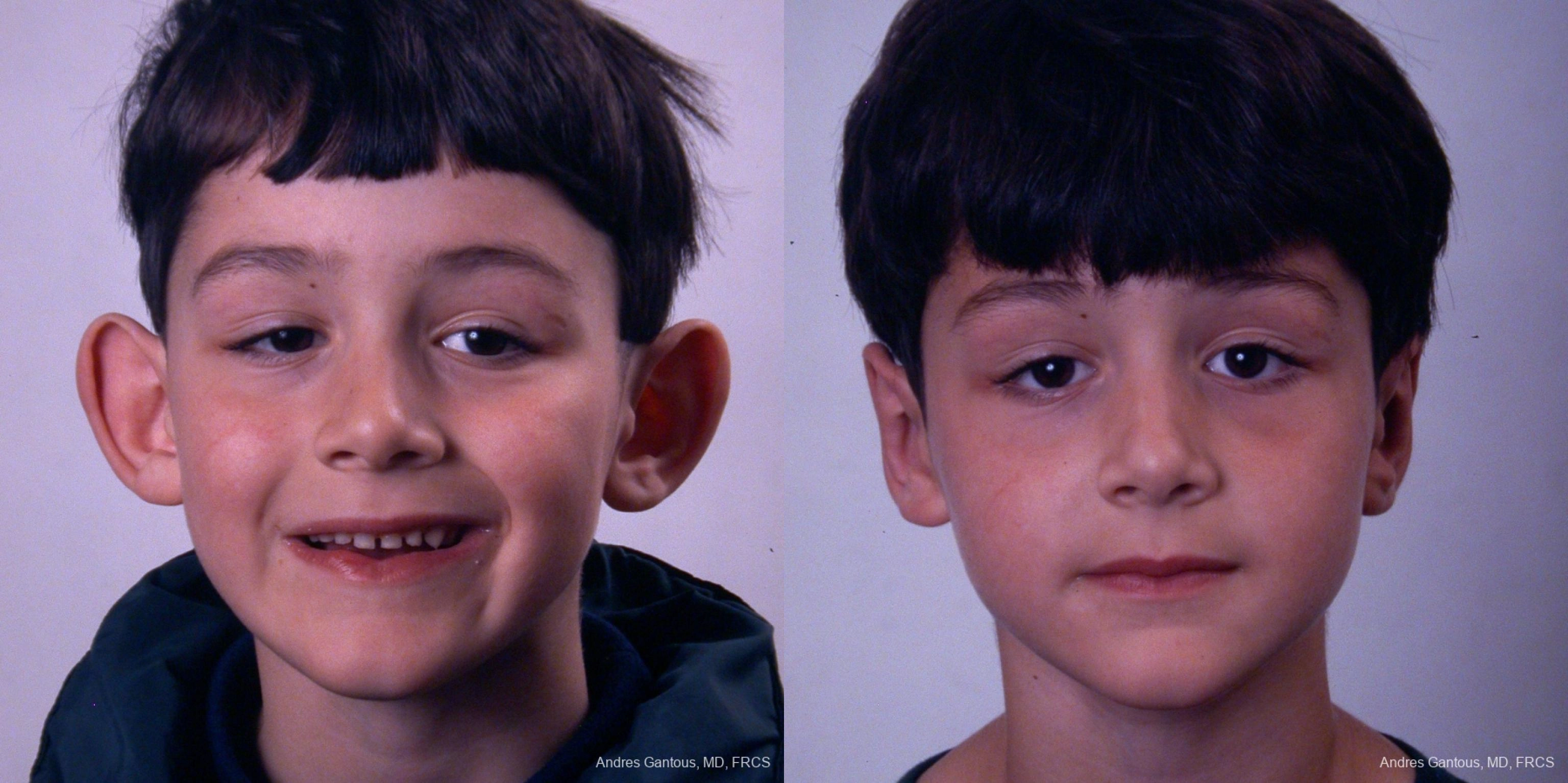 Otoplasty and Earlobe Repair - Case 6552