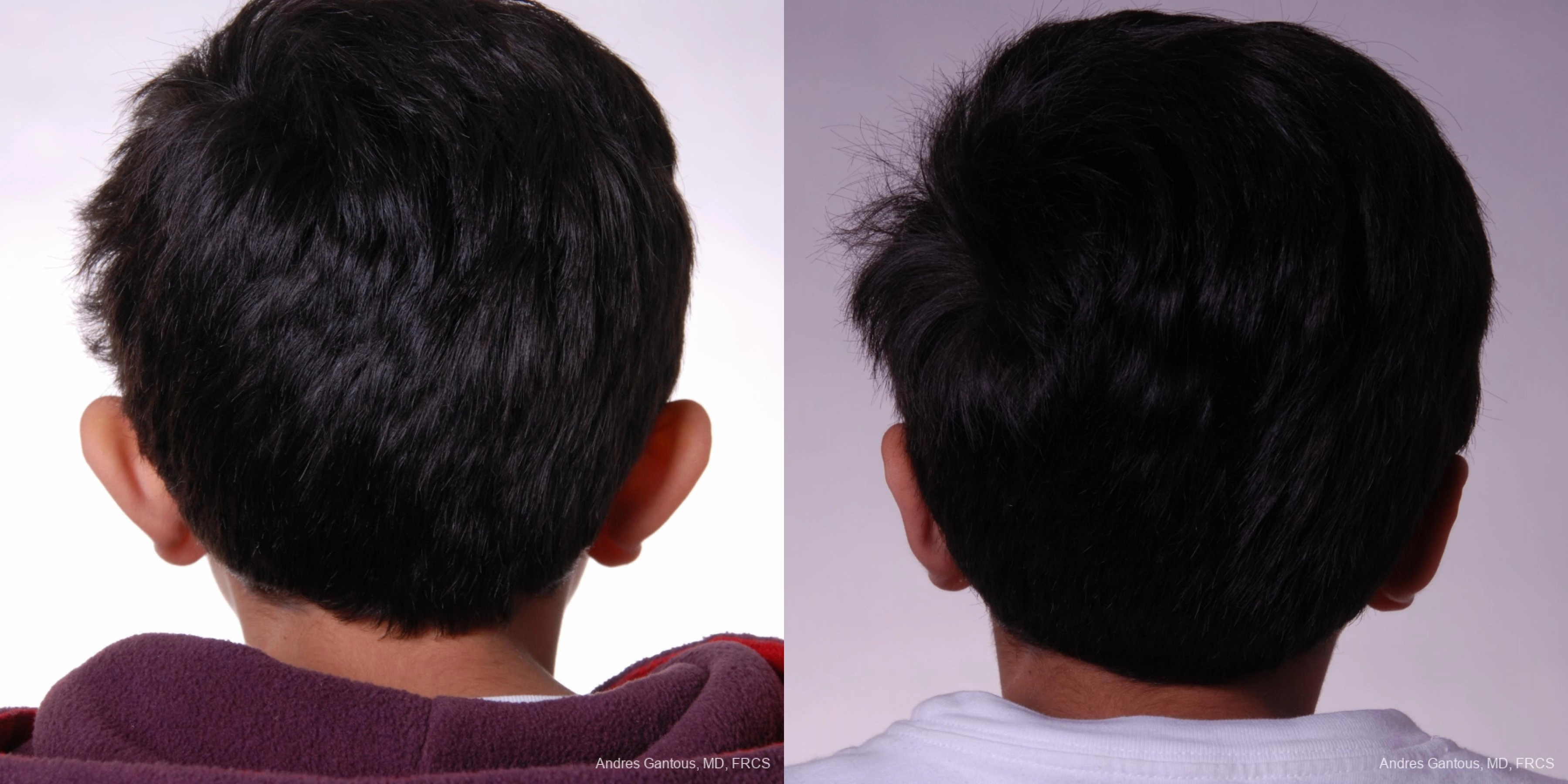 Otoplasty and Earlobe Repair - Thumbnail 2