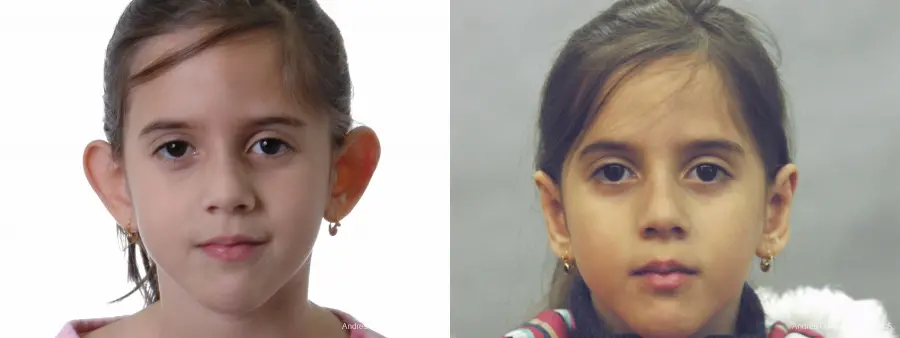 Otoplasty And Earlobe Repair: Patient 26 - Before and After