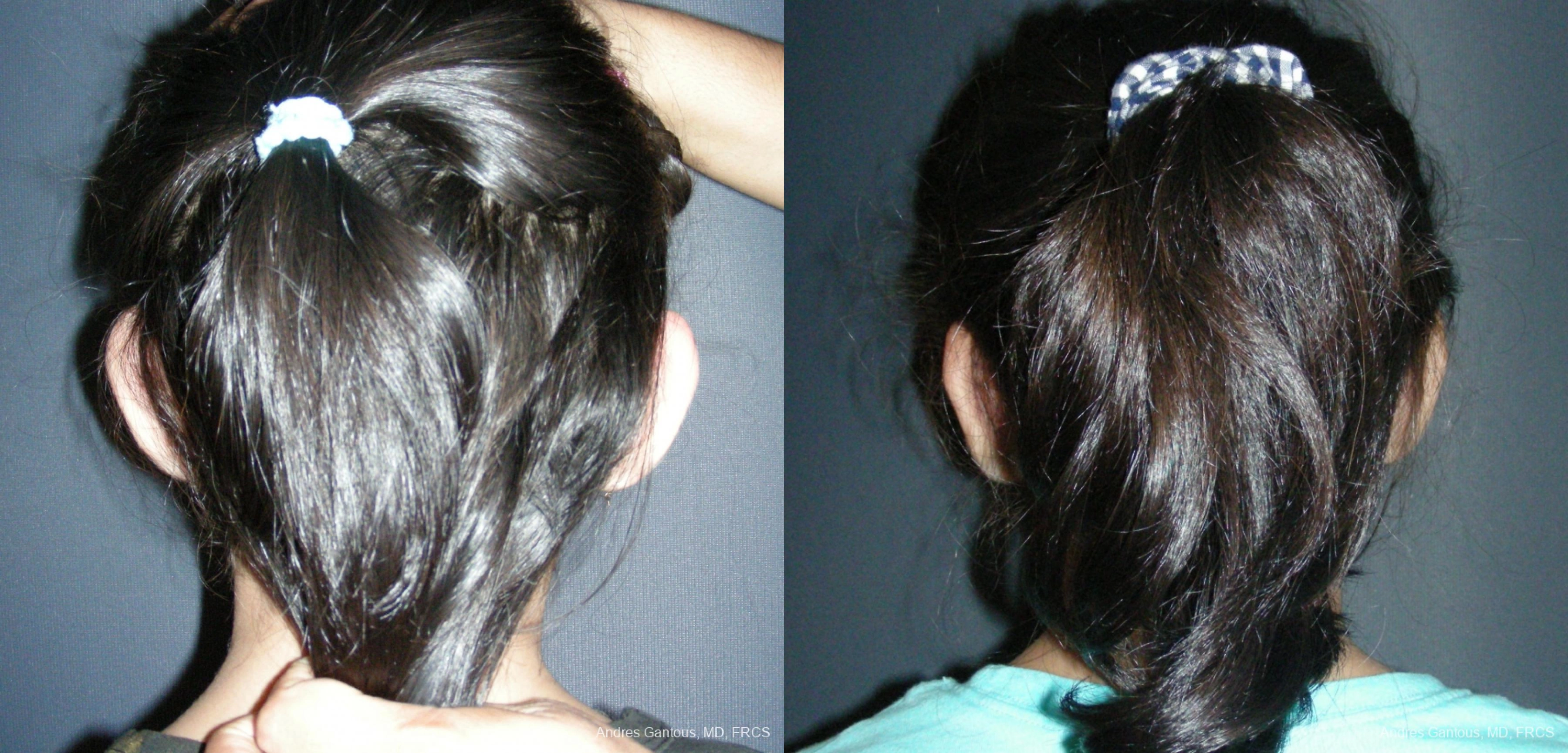 Otoplasty and Earlobe Repair - Thumbnail 2