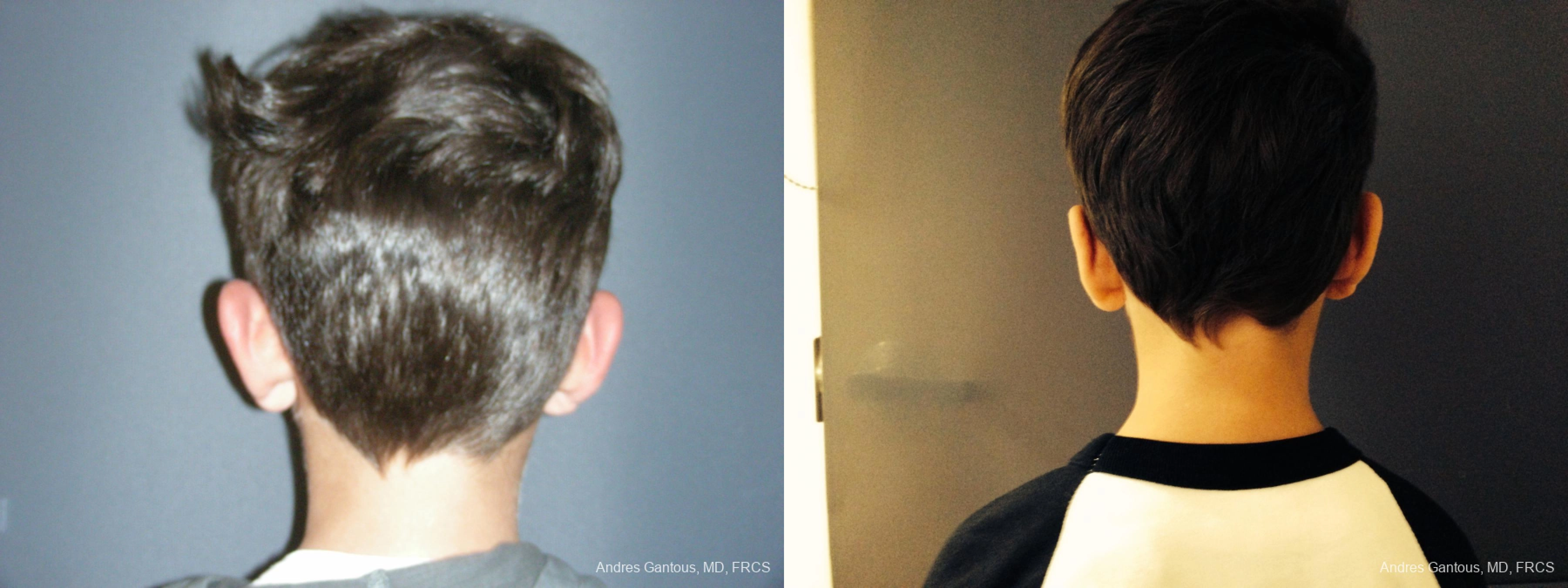 Otoplasty and Earlobe Repair - Thumbnail 6